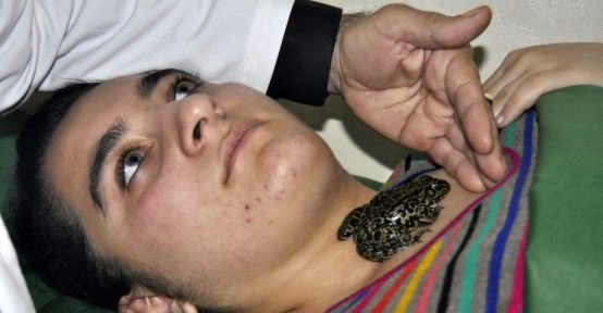 Azerbaycanda bir klinik guatr hastalarını kurbağa ile tedavi ediyor
